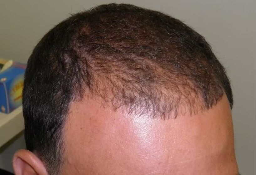 Hair loss before wearing verdoxidil