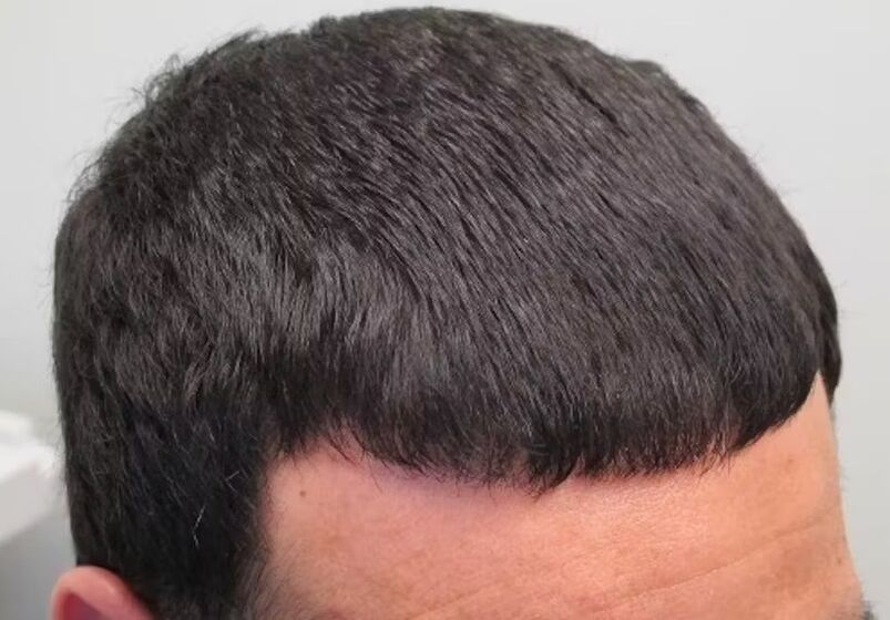 I healed Verdoxidil Hair Loss