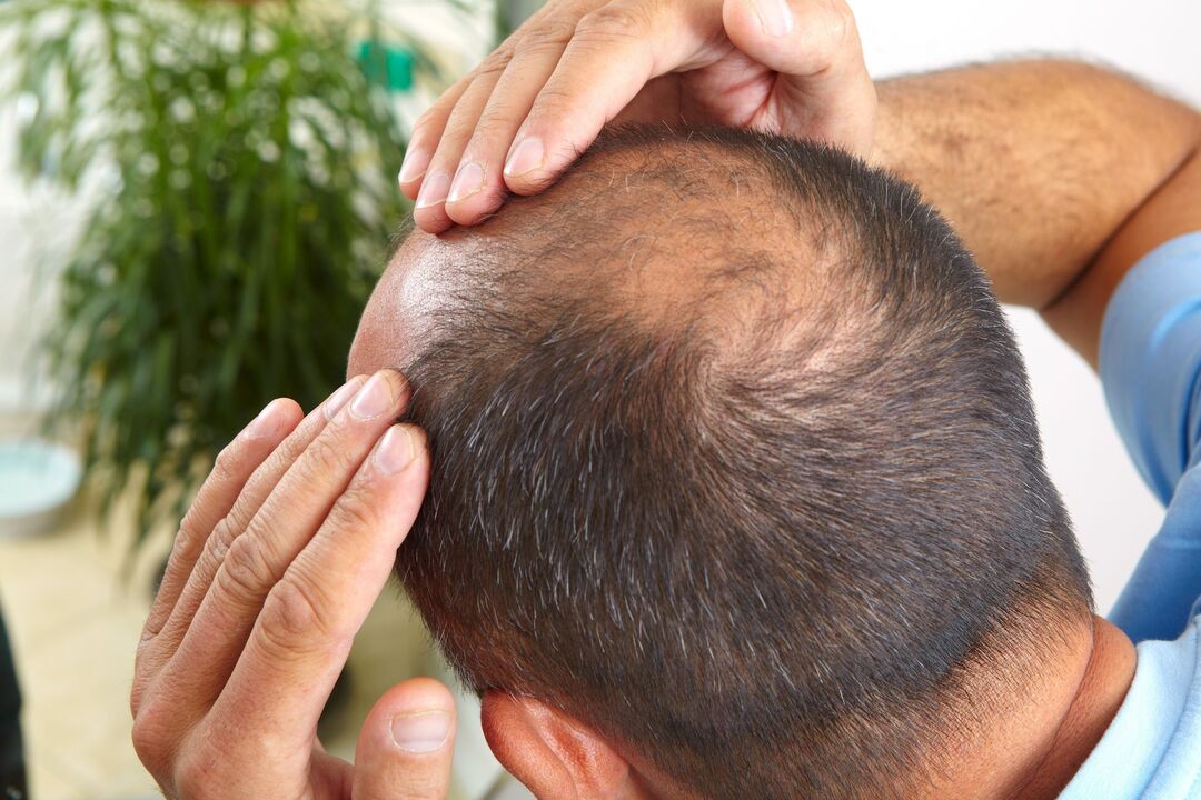 Rub the greenxedil spray for baldness treatment